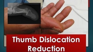 Thumb Dislocation Reduction [upl. by Whitnell]