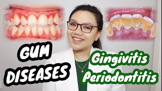 GUM DISEASE Gingivitis and Periodontitis 🦷 Namamagang gilagid masama ba  Dr Bianca Beley [upl. by Lotsirb752]