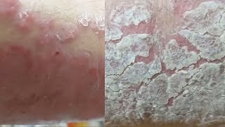 EXTREME REGENERATION 1 WEEK AFTER FULL CLEANING Psoriasis [upl. by Heath771]