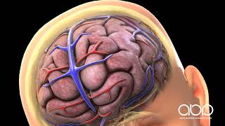 Hemorrhagic stroke epidural amp subdural hematoma  USMLE Step 1 [upl. by Purcell163]