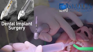 PreCovid19 Implant Surgery replacing front tooth [upl. by Lehet]