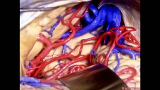 Ventricular Septal Defect Animation [upl. by Yodlem160]