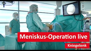 Kniegelenk MeniskusOperation live [upl. by Crofton659]