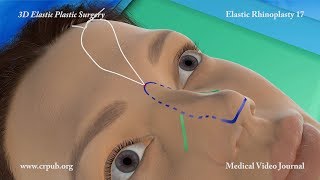 3D Elastic Rhinoplasty [upl. by Legge]