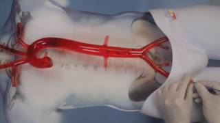 The ERREBOA™ Catheters Demonstration Video [upl. by Thalia]