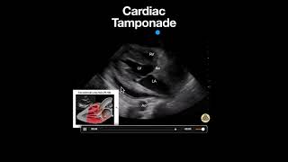 Cardiac Tamponade PSLA [upl. by Erdei]