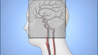 FİBROID EMBOLIZATION PAIN FREE [upl. by Eanahs]