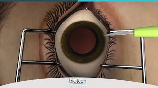 Eyecryl PHAKIC IOL Range Loading amp Implantation [upl. by Aroc]