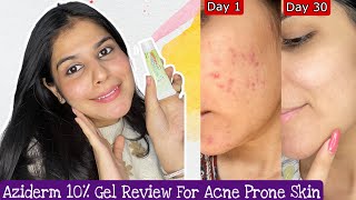 How To Treat Acne Scars  Aziderm 10 Cream Review [upl. by Woodford]