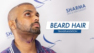 Beard to Scalp Hair Transplant [upl. by Ahsotan]