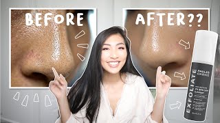 Remove blackheads on nose  Paulas Choice BHA exfoliant before and after [upl. by Nalyac]