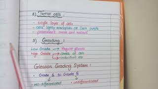 Prostate Carcinoma Pathology  Morphology and Gleason Grading [upl. by Panta464]