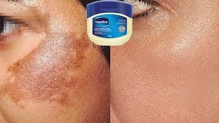 How To Use Vaseline To Remove Skin Pigmentation In Just 10 Days  Home Remedies [upl. by Mays]