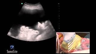 Acute Cholecystitis with Cholelithiasis  Ultrasound  Case 80 [upl. by Adnar]