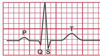 Normal EKG vs Heart Attack [upl. by Fulmer615]