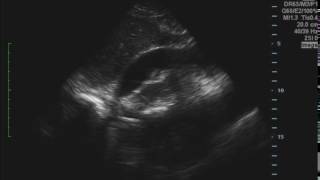 Cardiac Tamponade Ultrasound JETem 2016 [upl. by Adelpho640]