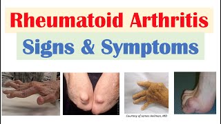 Acute Rheumatic Fever by E Rusingiza  OPENPediatrics [upl. by Egidius]