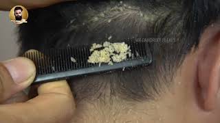 Removing Psoriasis From Scalp Dandruff Scratching 253 [upl. by Felicie]