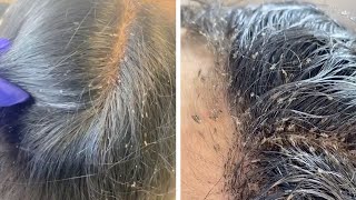 Hair Clinic Remove Hundreds Of Lice From Clients Head [upl. by Ener]