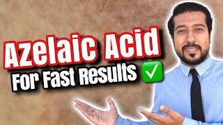 Azelaic Acid for Melasma  How to Use Azelaic Acid for SUCCESS 🏆 [upl. by Tavish]