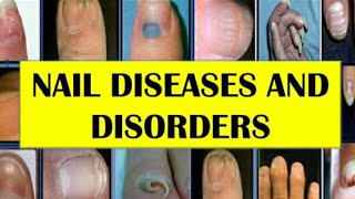 NAIL DISEASES AND DISORDERS [upl. by Rehotsirk]