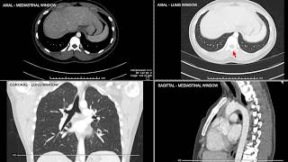 Introduction to Computed Tomographic imaging of the Chest [upl. by Smaoht]