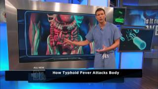 How Typhoid Fever Affects the Body  The Doctors [upl. by Yelserp797]