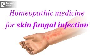 Homeopathic medicine for skin fungal infection  Dr Surekha Tiwari [upl. by Ayekim]