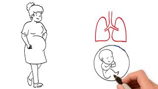 Bronchiolitis by A Growdon  OPENPediatrics [upl. by Shanahan]