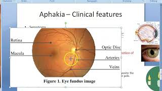 Ophthalmology 047 b Aphakia Clinical features [upl. by Suh]