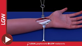 Wrist Fixator Surgery 3D Animation [upl. by Rhonda]