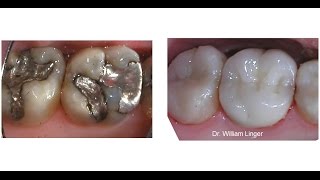 Mercury Amalgam Removal and Restoration [upl. by Oidale]