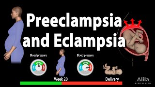 What is Preeclampsia Preeclampsia Animated Eclampsia [upl. by Dnomad]