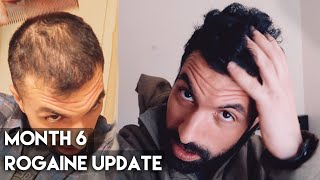 6 Month Rogaine Results Minoxidil [upl. by Mccreary133]