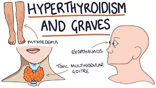 Approach to a Thyroid Nodule  causes investigation and treatment [upl. by Adnilg]