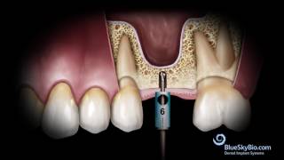 Advanced Simplified Sinus Lift Technique No Probe [upl. by Ahsiema]