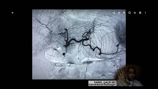 PPH Procedure Animation  Stapled Hemorrhoid Surgery  JampJ MedTech [upl. by Akemak]