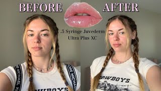 GETTING 05 SYRINGE OF JUVEDERM ULTRA PLUS XC before during amp after [upl. by Aivlys]