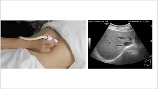 How To Ultrasound Guided Thoracentesis Exam 3D Video [upl. by Uahsoj]