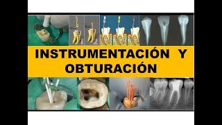 quotINSTRUMENTACION Y OBTURACIÓNquot por el Dr Nestor Jaime [upl. by Eiznekcam]