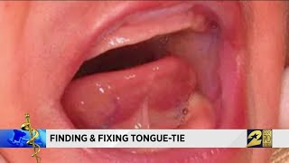 Finding and Fixing Tongue Tie [upl. by Asek]