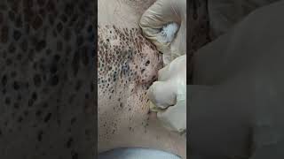 Nevus Comedonicus removal [upl. by Nicole352]