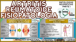 ARTRITIS REUMATOIDE FISIOPATOLOGÍA  GuiaMed [upl. by Earej]