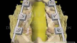 Lumbar Spine Pedicle Screw Fixation Fusion lawyer 3D animations [upl. by Skippy]