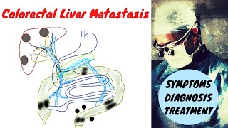 Rectal Cancer Anatomy  MRI Online [upl. by Assenal11]