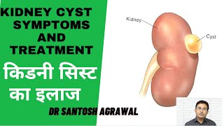 Symptoms of Kidney Cyst  Dr Vidyashankar Panchangam [upl. by Ennybor]