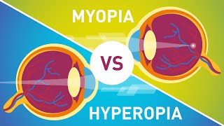 Myopia Signs and Symptoms Causes Diagnosis and Treatment [upl. by Atinel]