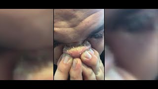 DIY Blackhead Removal Goes Viral [upl. by Venable]