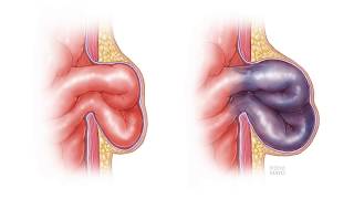 All About Peritoneal Tumours Causes Symptoms Diagnosis and Treatment [upl. by Petigny]