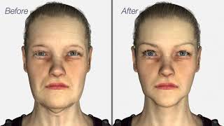 Facelift amp Neck Lift surgery  Dr Julian De Silva  3D medical animation [upl. by Synned]